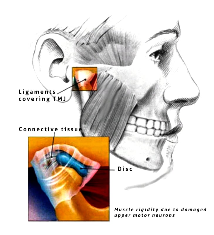 Stop Teeth Grinding Relieve TMJ Hypnoconsult, LLC.